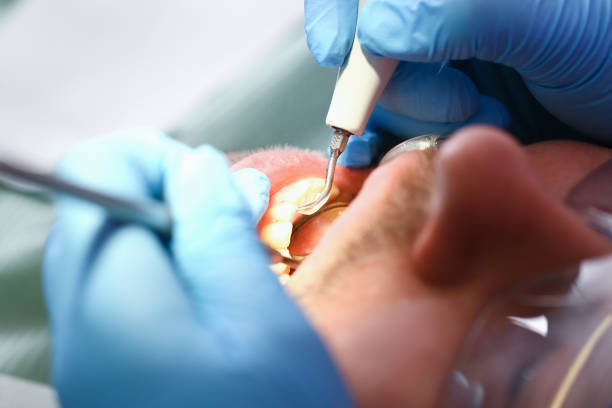 Best Emergency Root Canal Treatment in Brookston, IN